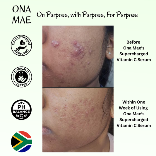 Ona Mae Acne Treatment. Ona Mae Dark Marks Treatment.