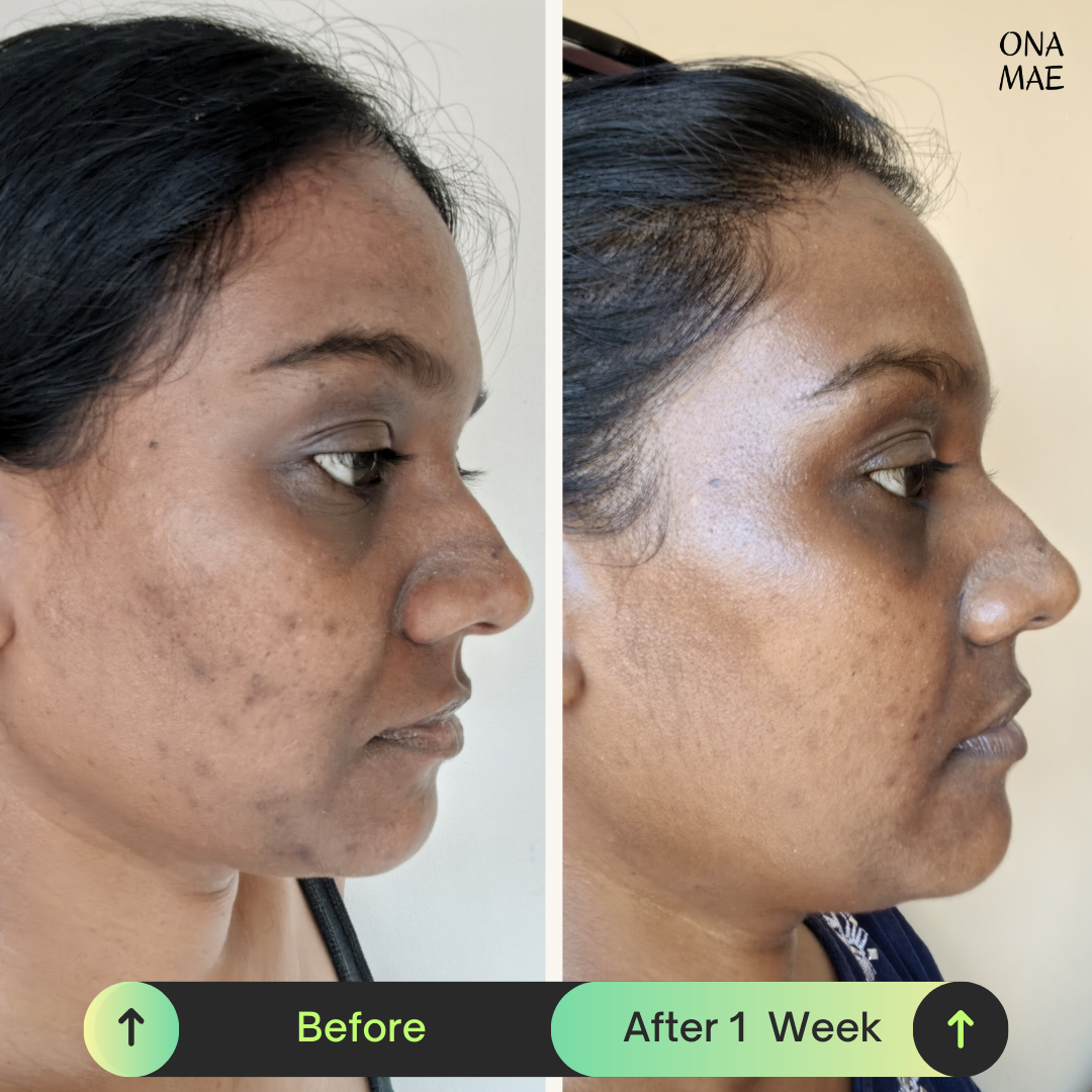 Ona Mae 1 week skin transformation