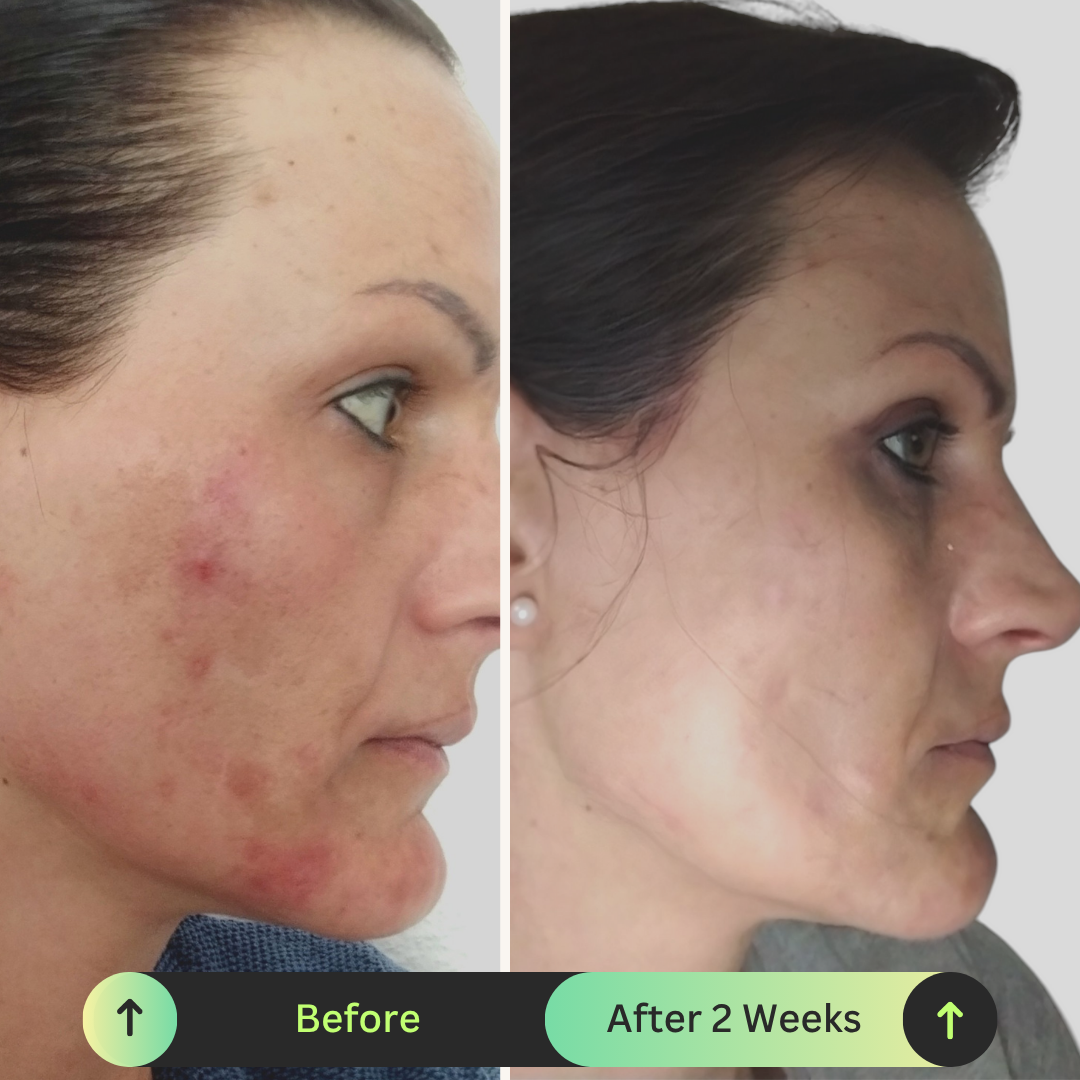 ONA MAE Supercharged Vitamin C Serum for hyperpigmentation results Before and after comparison of a woman's face with acne, showing improvement over 2 weeks.