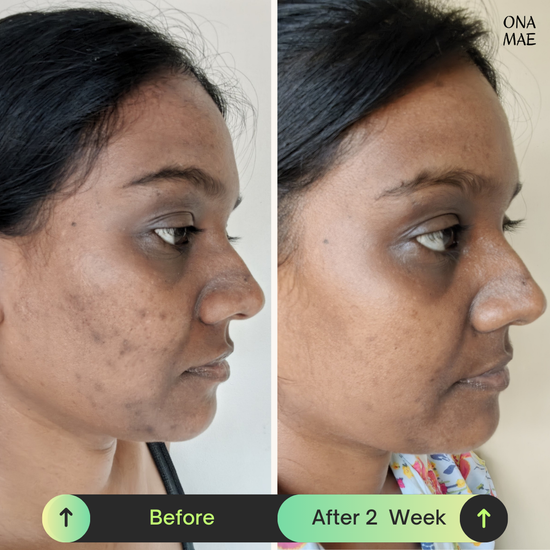 Ona Mae Skin Results