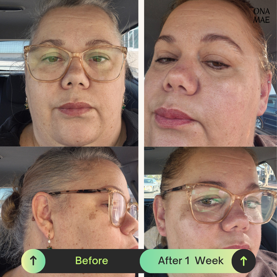 Ona Mae Skin Results