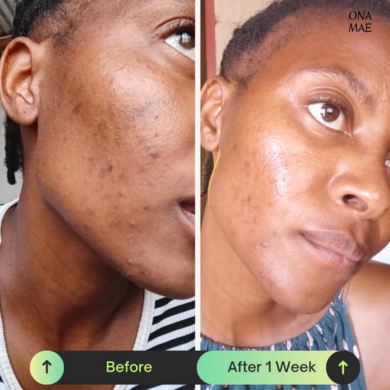 Ona Mae Skin Results