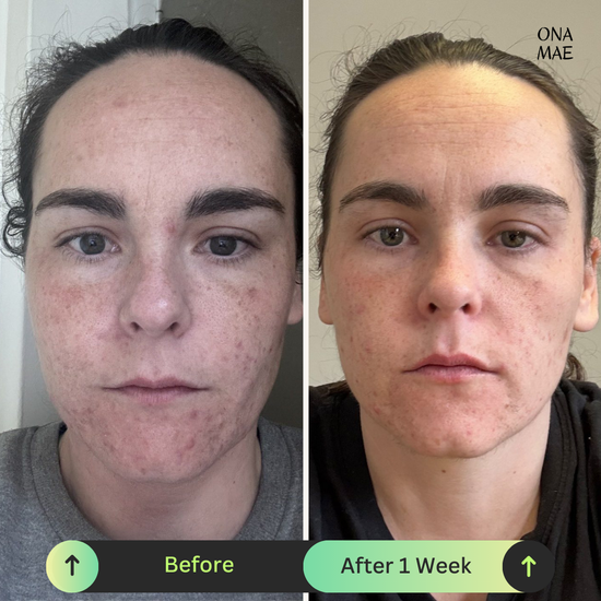 Ona Mae Skin Results