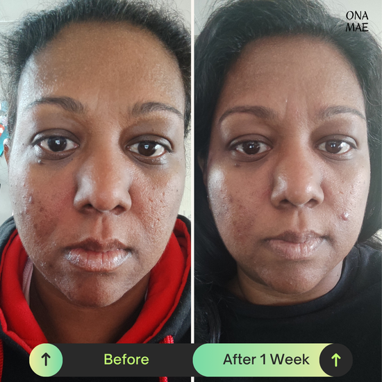 Ona Mae Skin Results