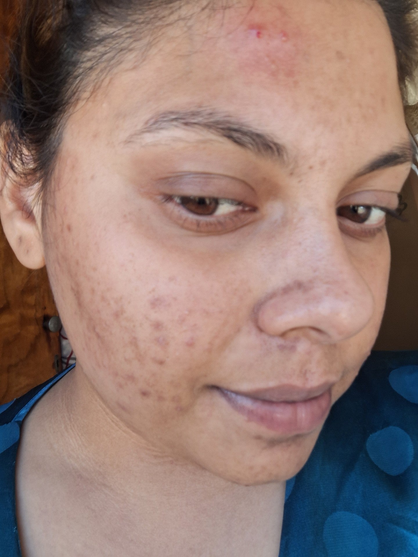 Close-up of a person's face with visible acne and skin concerns.