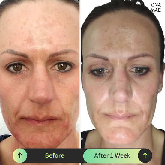 Ona Mae Skin Transformation