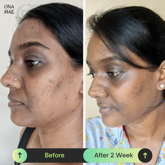 Ona Mae Skin Transformation