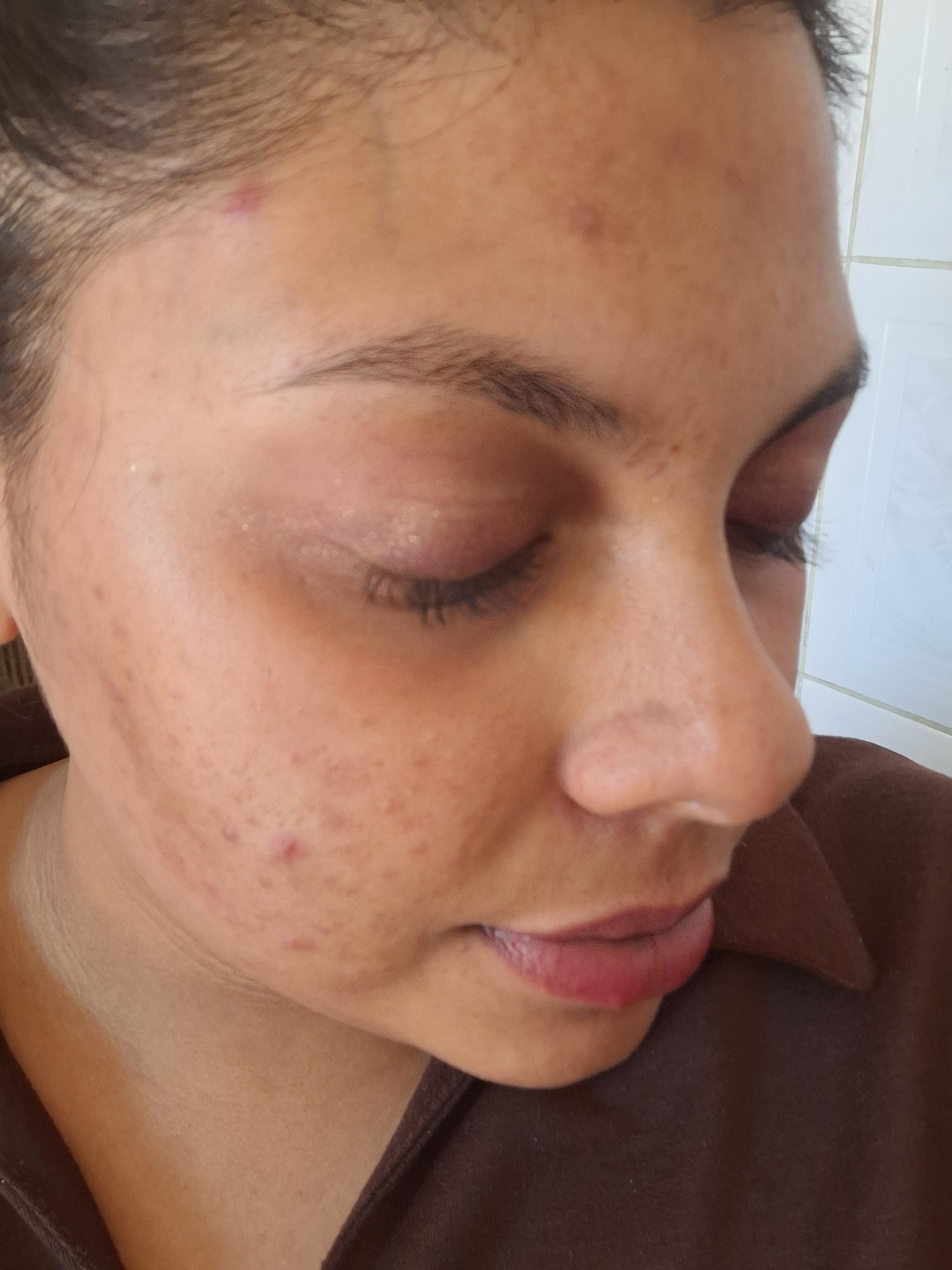 Close-up of a person's face with visible skin improvements.